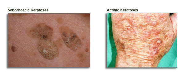 Keratoses