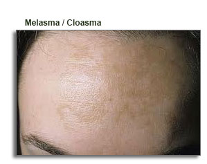 Melasma-Cloasma
