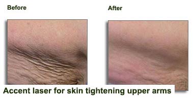 Accent-for-skin-tightening