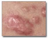 Hypertrophic-Keloid-Scars