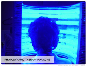 Photodynamic-therapy-for-Acne