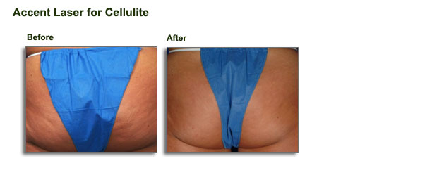accent-laser-for-cellulite