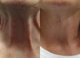 Botox For Lower Neck