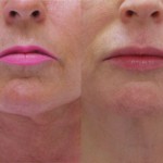 Botox For DAO Muscle, Juvederm Upper Lips