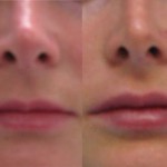 Juvederm Lips