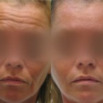 Botox Forehead Lines, Juvederm Smile Lines