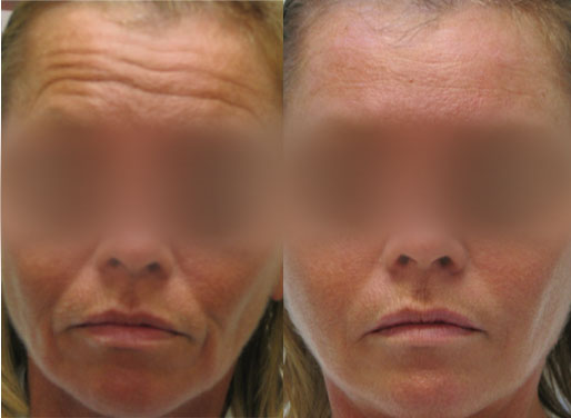 Botox Forehead Lines, Juvederm Smile Lines