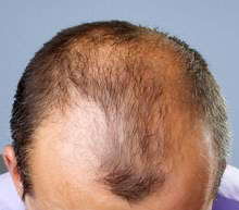 men-hair-loss