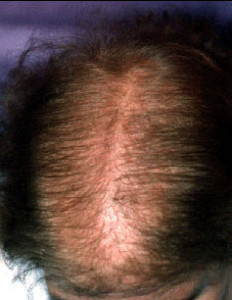 woman-hairloss