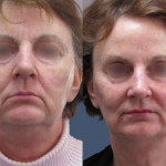 Botox & Juvederm Softlift