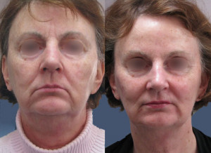 Botox-&-Juvederm-Softlift