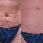 Lazer Room Patient - Body after Baby - skin tightening and roller therapy
