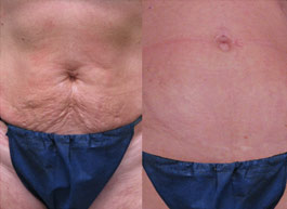 Lazer Room Patient - Body after Baby - skin tightening and roller therapy