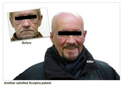 St.-John's-man---another-happy-Sculptra-patient