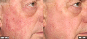 actinic-keratoses