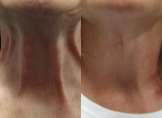 botox for neck