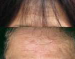 Selphyl Forehead Lines