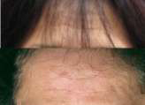 forehead lines before and after Selphyl 