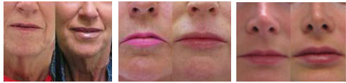 Juvederm For Lips