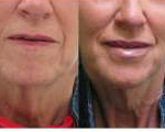 Juvederm Lips & Cheeks