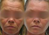 Botox for Forehead Lines
